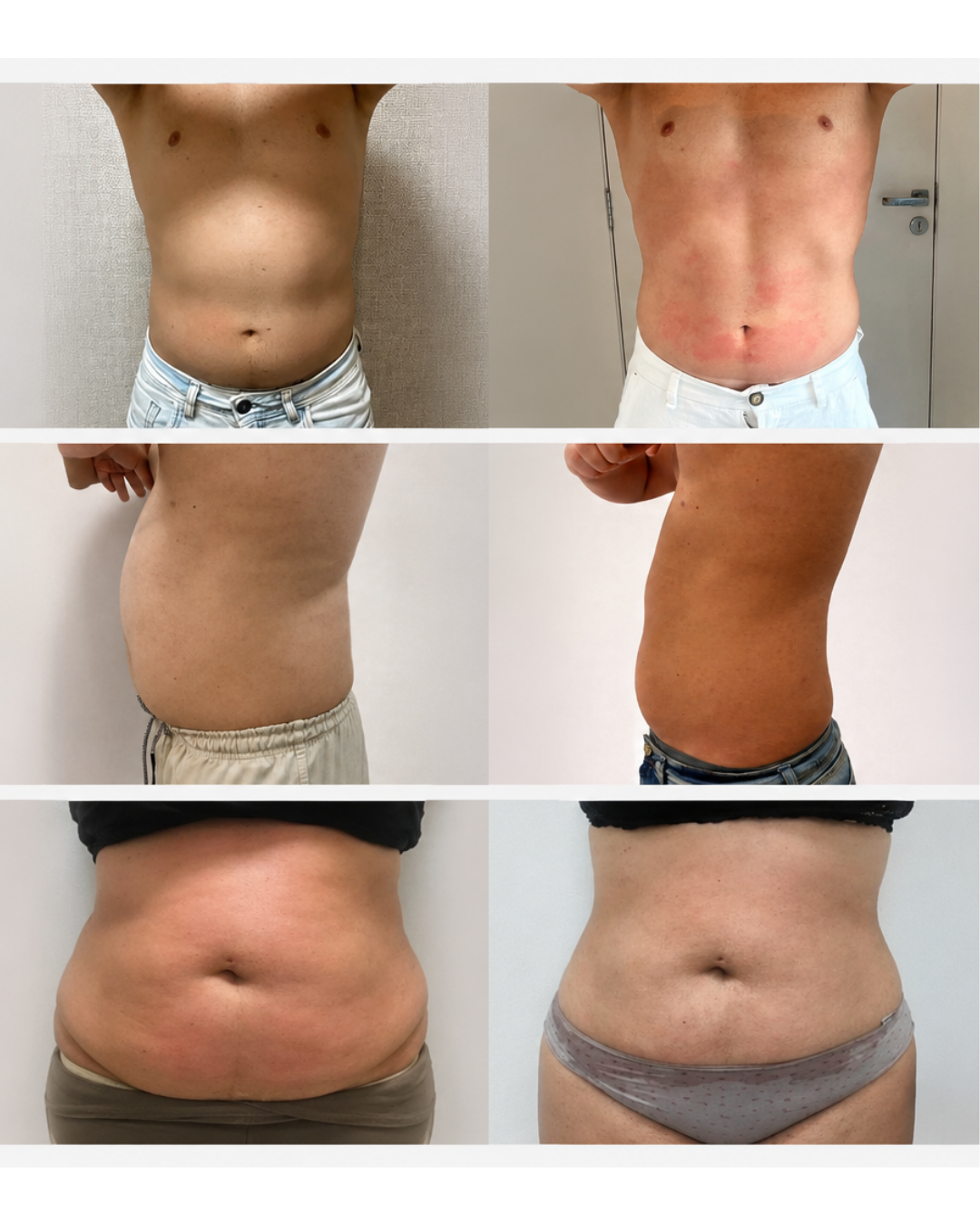 Resultados reais de criolipólise — antes e depois